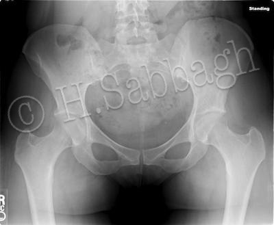 Bio-mechanical Dysfunction of a Pre-arthritic Hip