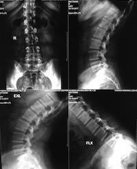 Spinal Inter-segmental Instability; Diagnosis and Clinical Implications