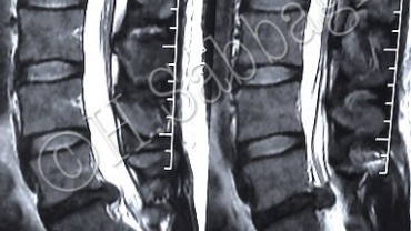 Left L5-S1 Subarticular Herniation with Corresponding Lateral Recess Compromise (CS-25)