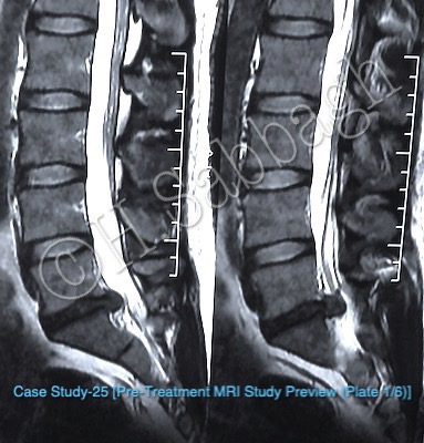 Left L5-S1 Subarticular Herniation with Corresponding Lateral Recess Compromise (CR – 25)