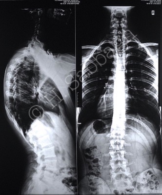 The importance of Accurate Diagnosis / Prognosis in Chiropractic Management of Scoliosis & Hyper-Kyphosis of the Spinal Column – Introduction