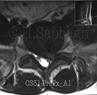 Left L5-S1 Sub-articular – Lateral Recess Herniation  (CS-31)