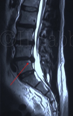 L4-5 Posterior Central Left Outer Annular Herniation – Acute Moderate L4-5 Radiculitis – Complicated by L4-5 Posterior Compartment Instability (Case Report – 32)