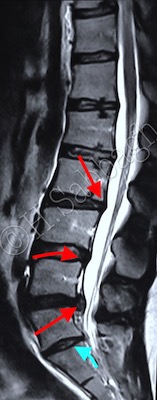 Sub-ligamentous L5-S1 Extrusion with Left Sub-articular Space Compromise (CR – 20)