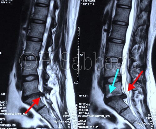 Right Paracentral L5-S1 Herniation – Lateral Recess Compromise Complicated by L5 Structural Retrolisthesis and Modic Type II Changes (CR – 30)
