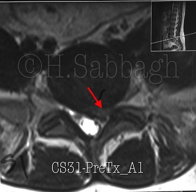 L5-S1 Sub-articular Herniation  (CR – 31)